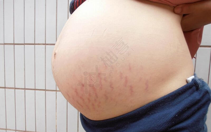 孕期妊辰纹