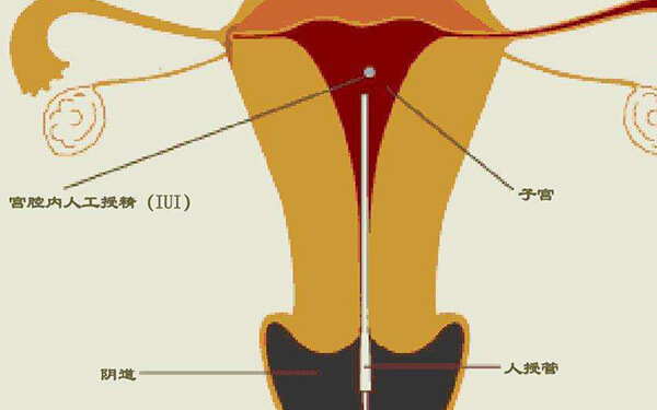 从检查到验孕5步走！宫腔内人工授精全过程整理