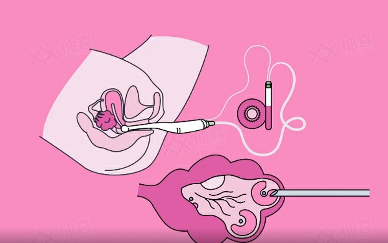 体外受精:辅助生殖中最早期的一种试管婴儿技术