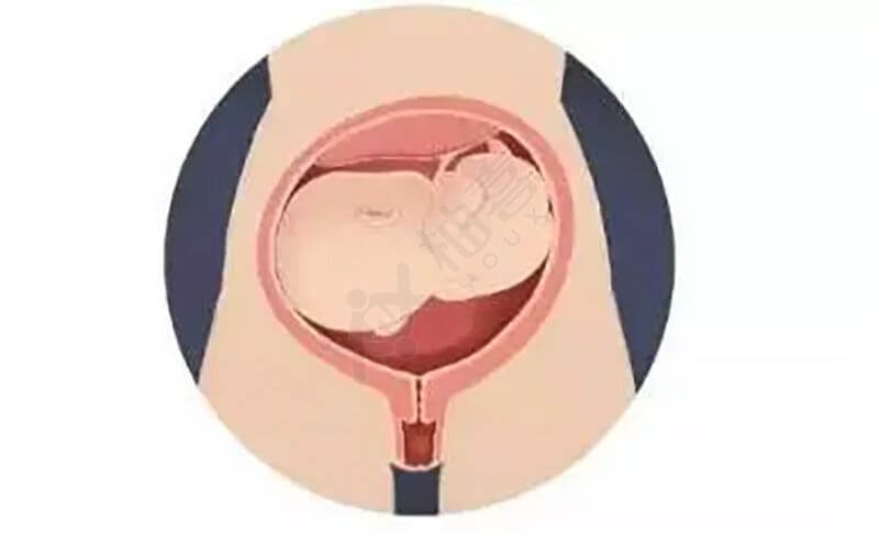 胎儿横位