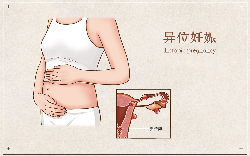 输卵管妊娠会降低以后怀孕几率