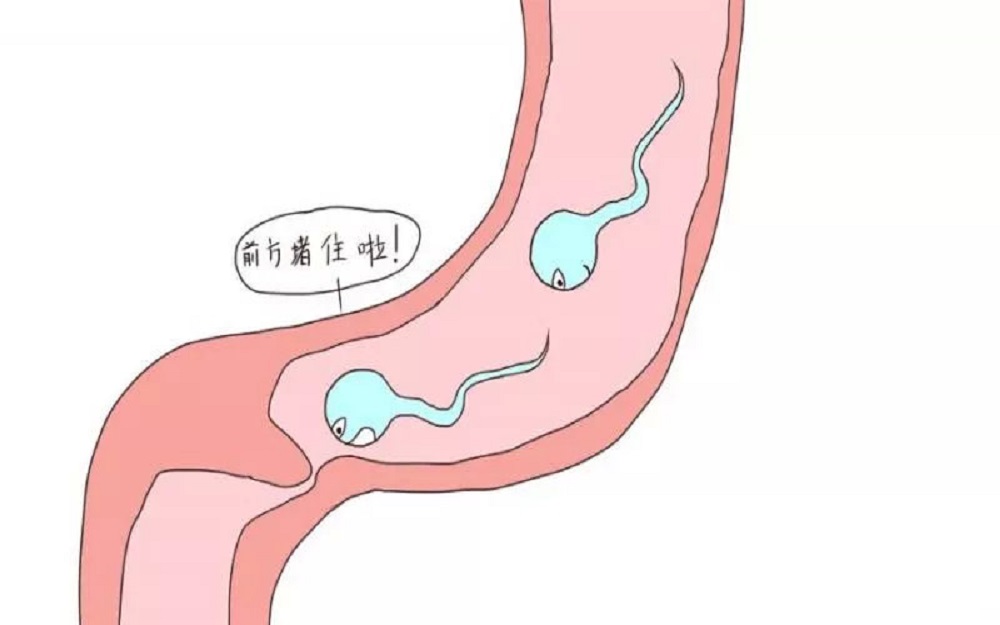 输卵管堵塞会导致不孕