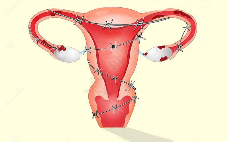 子宫内膜组织植入子宫外