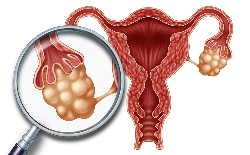 宫腔粘连检查方法及症状