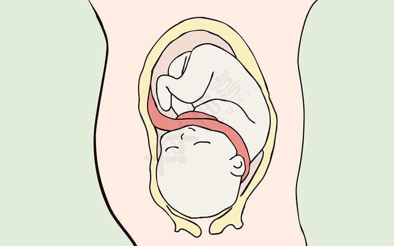 胎儿脐带绕颈