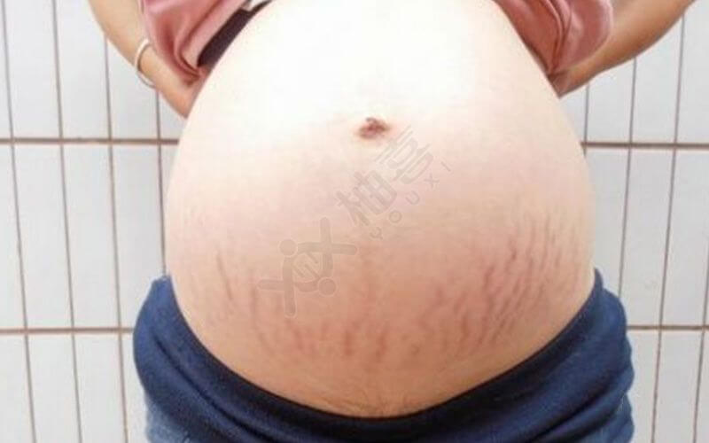 妊娠纹能消除吗