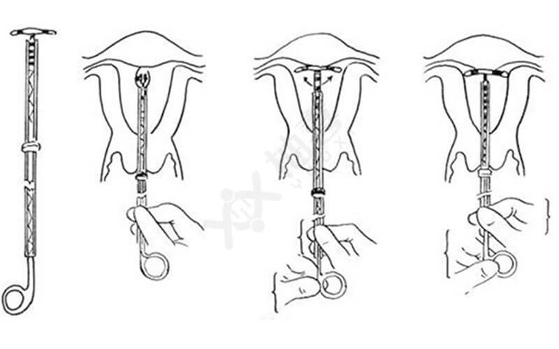 宫内节育环