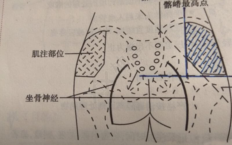 臀大肌注射定位法图片