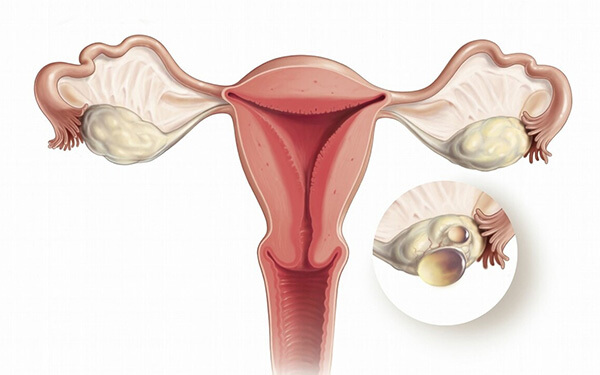 取卵后卵巢囊肿有什么症状？出现这些反应暗示已中招