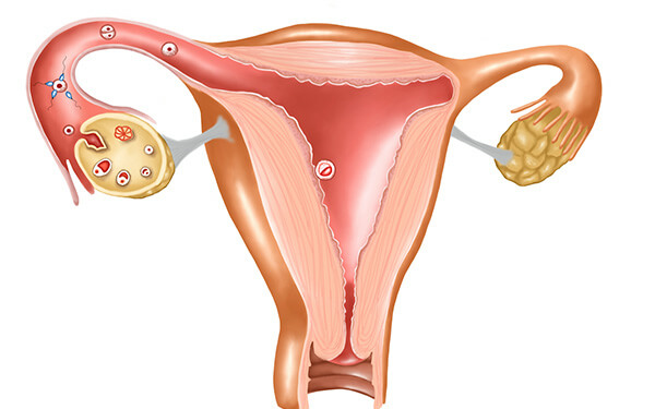 子宫肌瘤患病率达25%，是否影响试管婴儿怀孕成功率？
