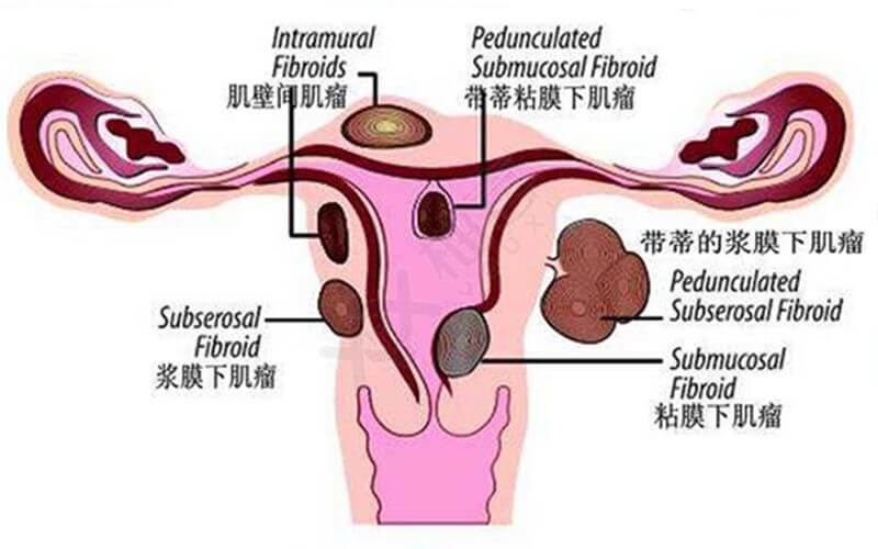 子宫肌瘤试管婴儿饮食禁忌