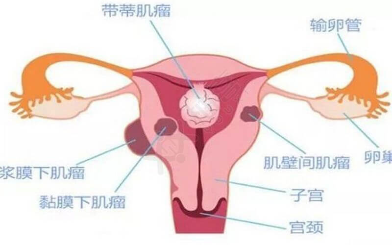 子宫肌瘤的分型