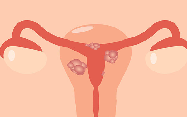 子宫肌瘤试管婴儿助孕？掌握这些好孕更简单