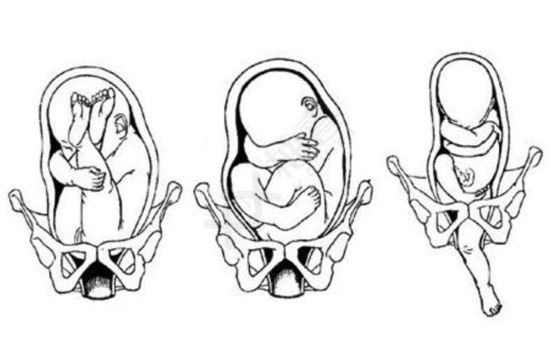 胎位不正的三种原因