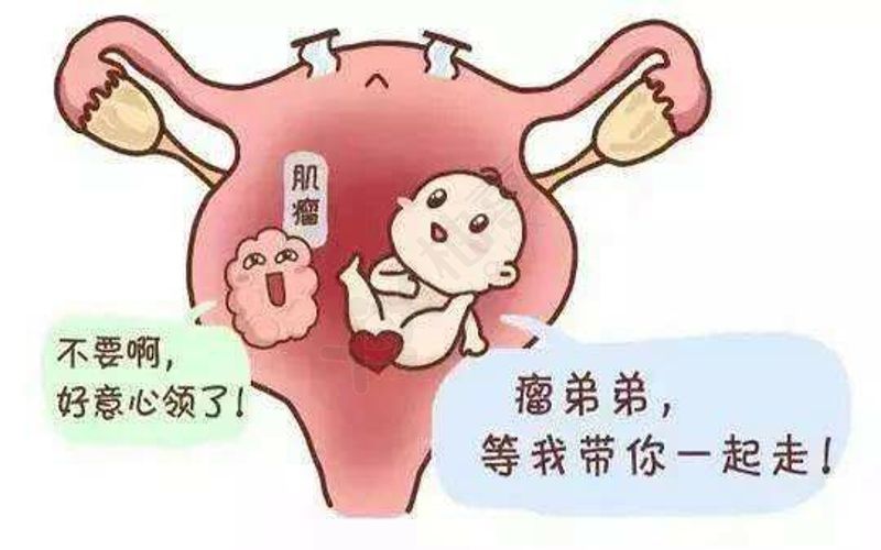 子宫肌瘤导致不孕