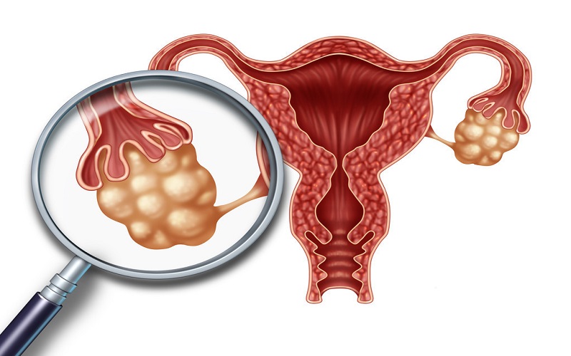 服用克罗米芬导致卵巢过度刺激综合征