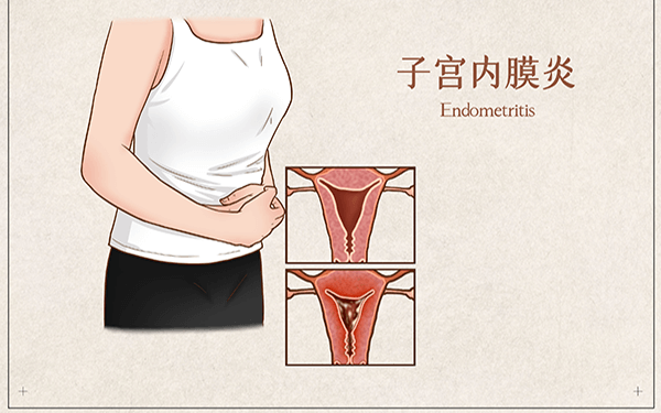 育龄妇女患有子宫内膜异位症有哪些症状？会痛经吗?