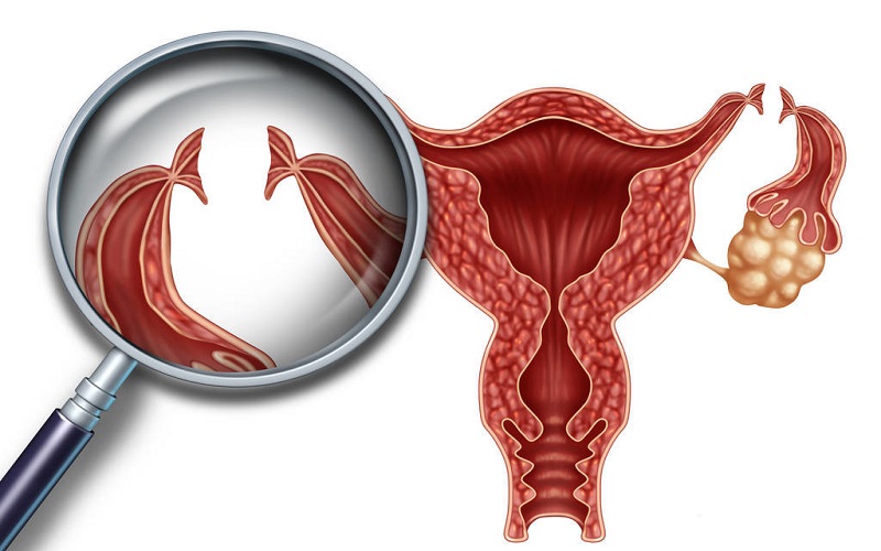 输卵管炎导致宫外孕