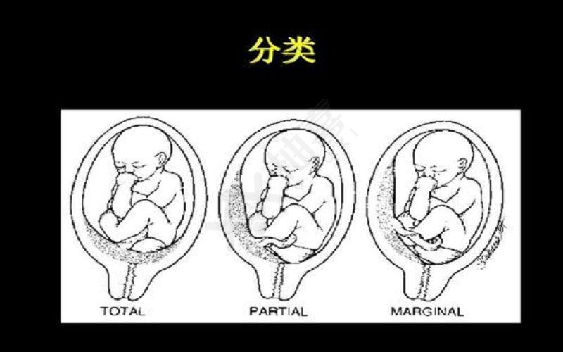 胎盘低置等胎盘位置分类图