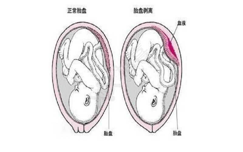 胎盘低置图