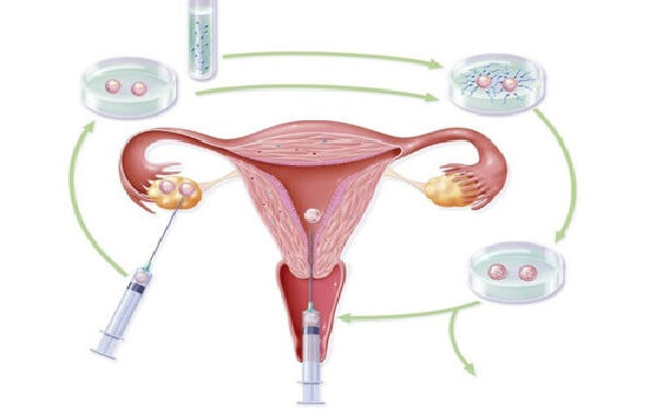 试管婴儿微刺激促排卵方案适用于多囊卵巢患者吗？