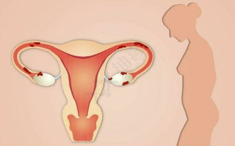 醋酸加尼瑞克能避免卵巢刺激