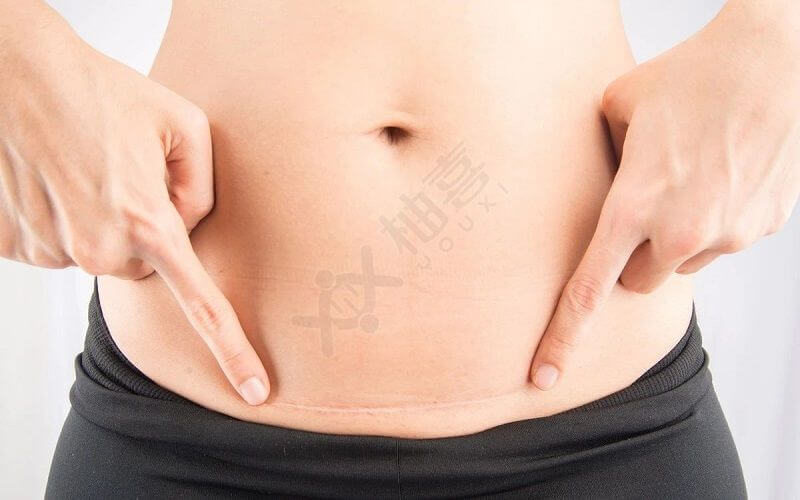 剖宫产瘢痕妊娠分型