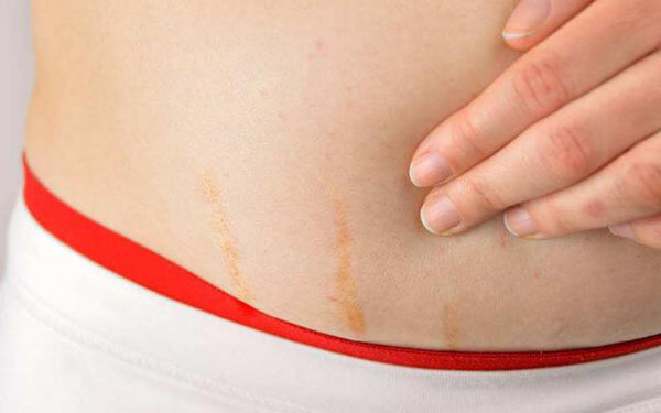 孕妇妊娠纹去除小偏方，肥胖纹快速消除经验分享
