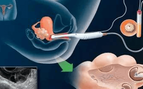 囊胚移植后出现阴道出血别着急，这可能是成功的征兆！