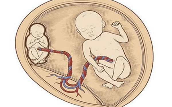 怀上同卵双胞胎别高兴太早！对孕妇和胎儿的危害得知道