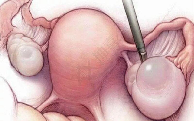 卵巢囊肿会让女性月经不调