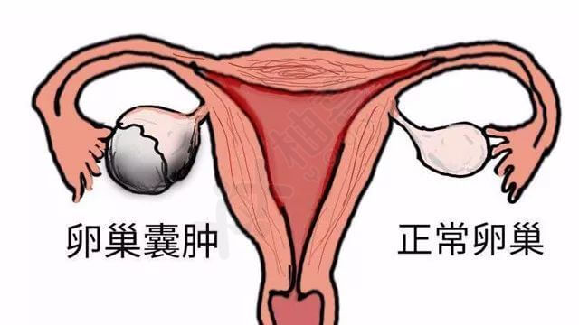 卵巢囊肿如图所示