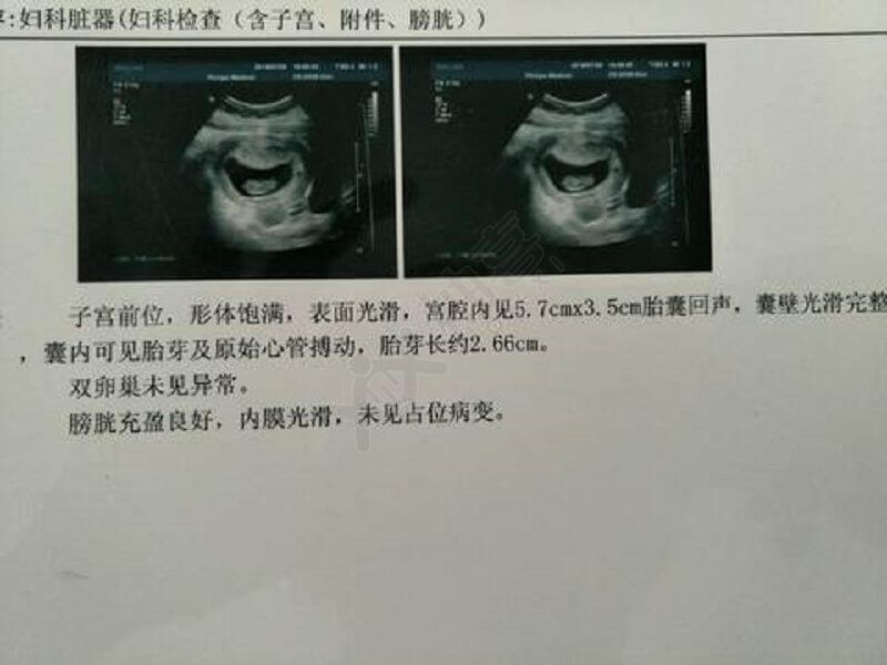 B超单上的图片可以看宝宝的形状