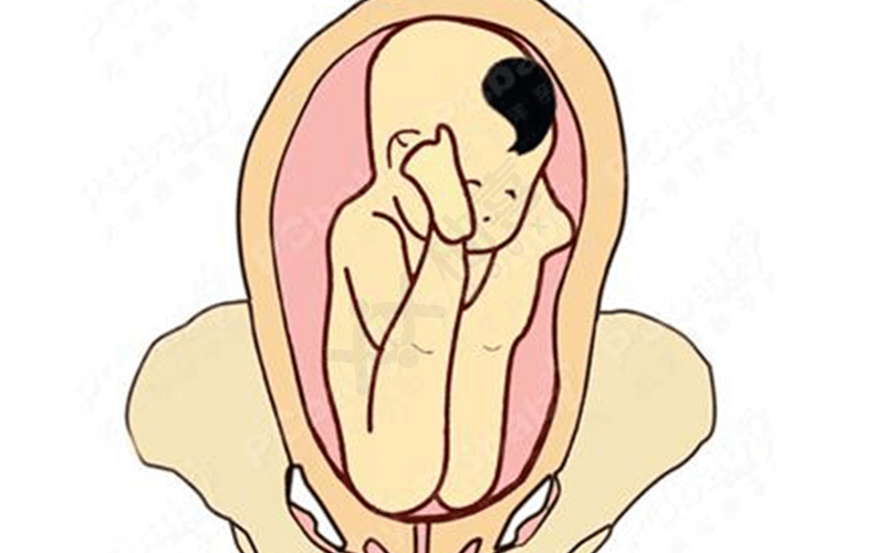 胎儿臀位是胎位不正的一种