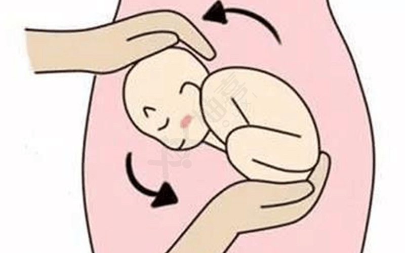 胎儿臀位可以采取外转胎位术纠正