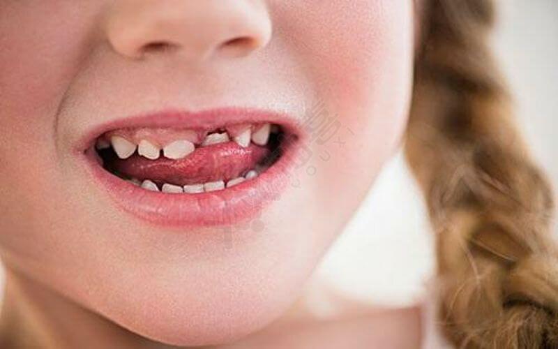 长期使用安抚奶嘴导致孩子牙齿不整齐