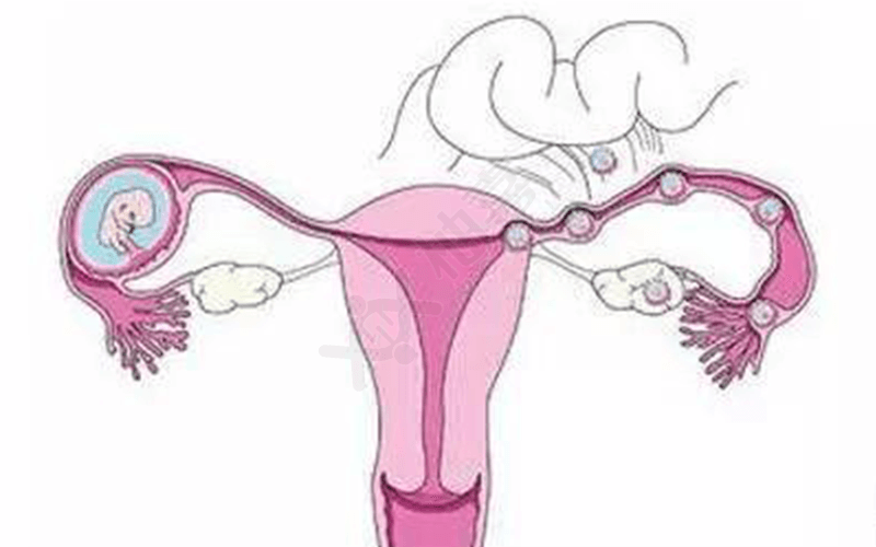 输卵管异常是引起宫外孕的重要原因