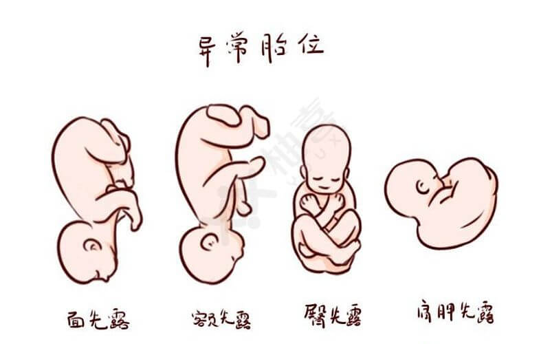 孕晚期rop胎位图图片