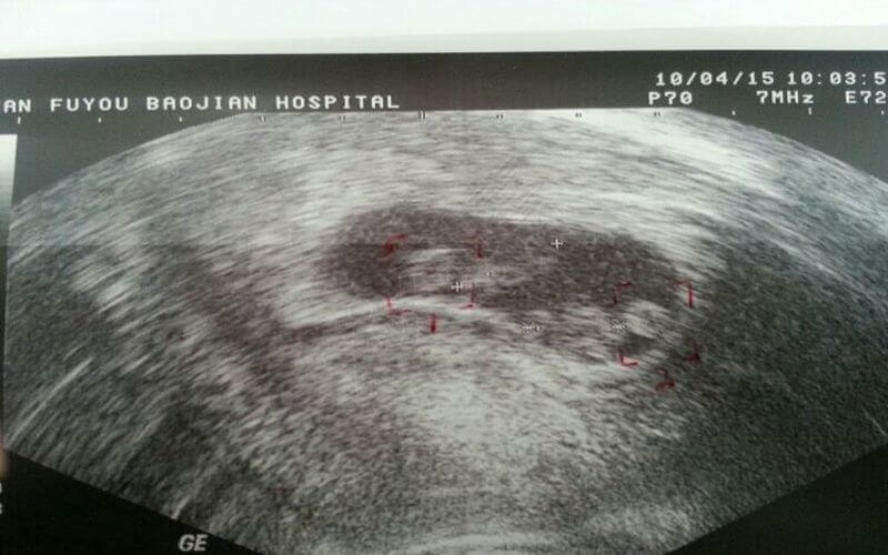 异卵双胎分娩之前医生会对孕妇做B超检查