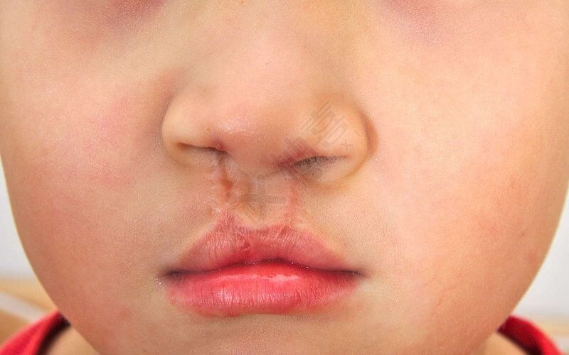 胎儿唇裂属于先天畸形