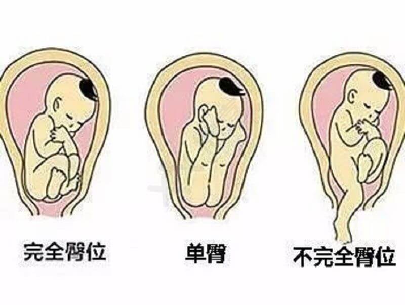臀位胎儿的方式
