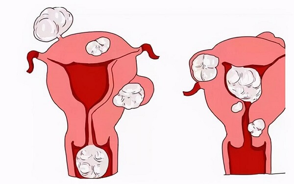 再问子宫腺肌症能不能怀孕就out了，用4种方法可子孙满堂