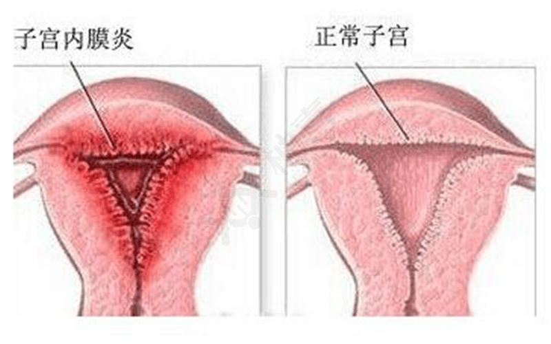 子宫内膜炎是女性常见疾病