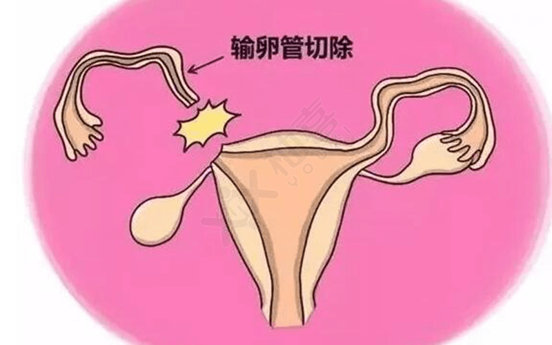 输卵管切除后能否怀孕要看情况