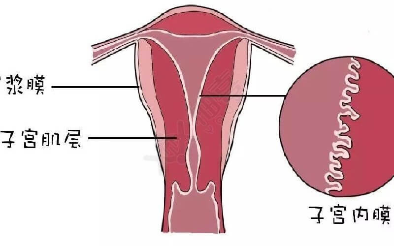 子宫腺肌症会导致女性不孕