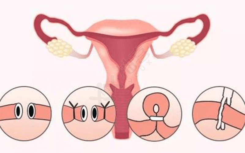 输卵管切除对女性的影响很大