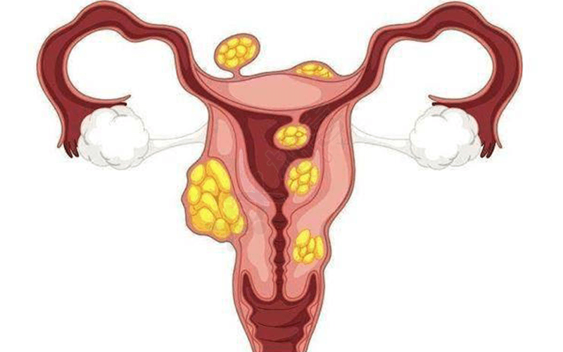 子宫息肉是常见的妇科疾病