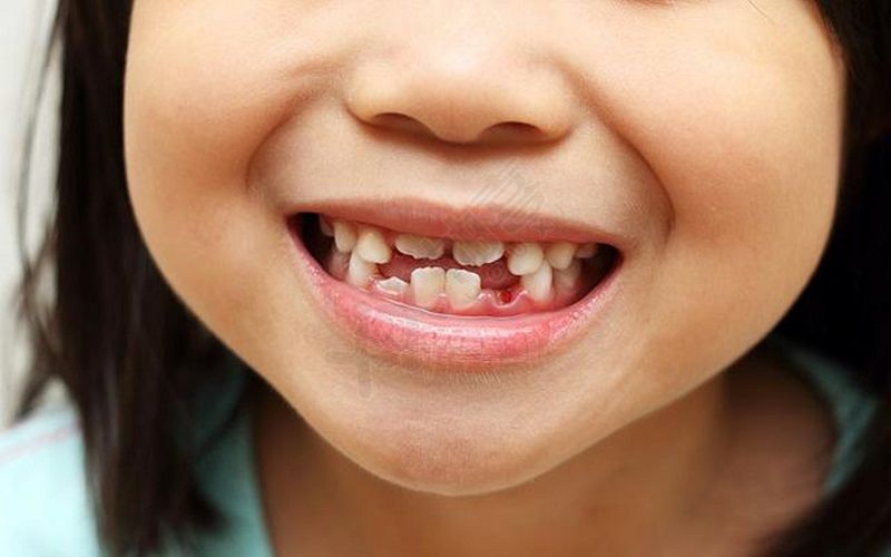 儿童换牙期间需注意促进钙质的吸收
