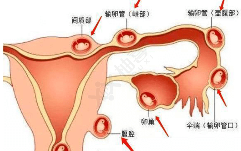 宫外孕腹痛位置图片图片