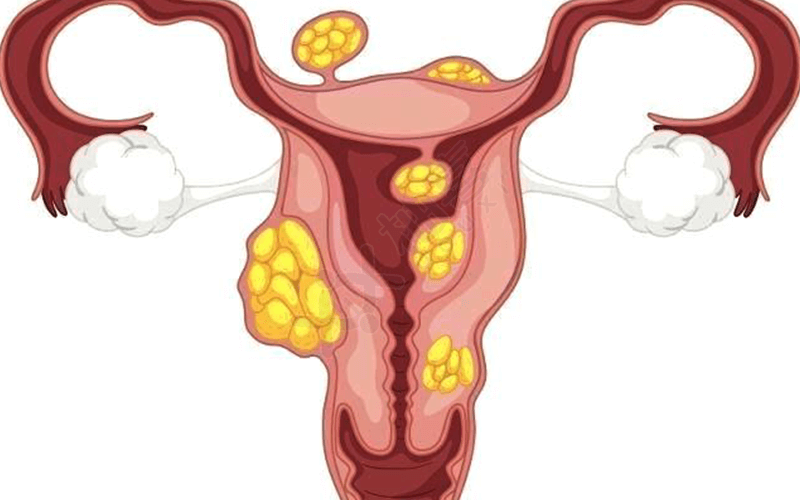 宫外孕的原因有子宫肌瘤